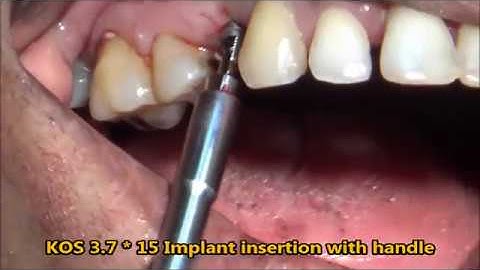 Flapless keyhole basal implant procedure for upper premolar