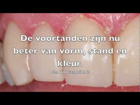 Video: De laatste fase van de behandeling bij de tandarts