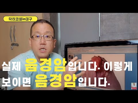 실제 음경암입니다. 이렇게 보이면 음경암입니다.(남성은 꼭 보셔야 합니다) [닥터코넬]