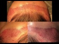 Female Hairline Lowering Step-by-Step Recipient Site Design in Dallas, TX