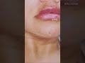 #lipfiller #lip-augmentation @dra.sherinal.shahbazianm.d9071 #shorts #love #toxinabotulinica #amor