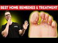 Athlete's Foot Fungus [BEST Home Remedies & Treatment 2021]