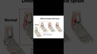Calf Raise Test for Lateral Ankle Sprain | Quick Exam Guide | #meded #anklepain #physiotherapy