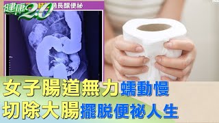 女子腸道無力蠕動慢 切除大腸擺脫便祕人生 健康2.0