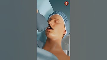 Achalasie dilatatie 😮 #3danimation