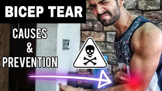 Bicep Tendon Tear - Causes & Prevention [HINDI]