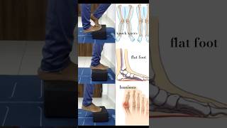 Flat feet, bunions and knock knees? DO THIS DAILY! #yoga #trust #viral