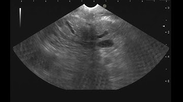 EUS sampling of mass obstructing the PD