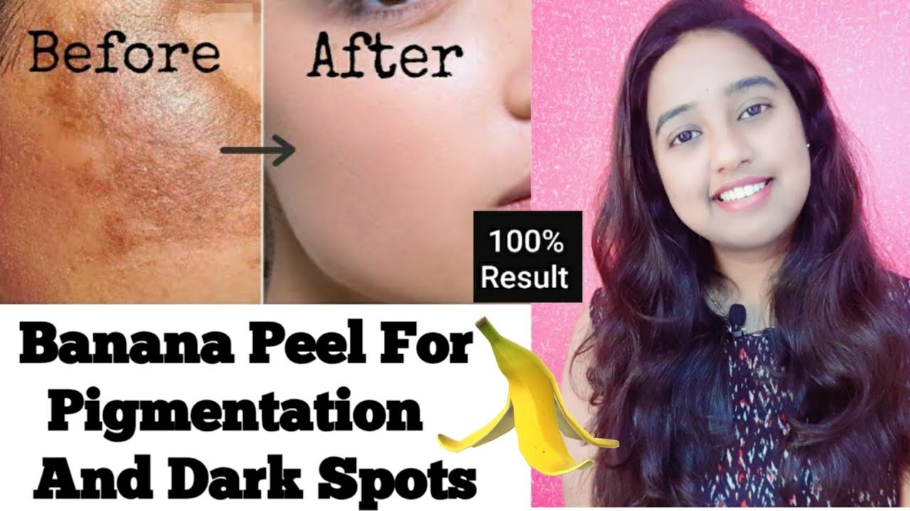 Featured image of post Does Banana Peel Get Rid Of Spots / Banana peels are loaded with antioxidants such as lutein that help protect the skin against damage causing factors like banana peel helps boost your skin&#039;s health with its fatty acid and antioxidant content.