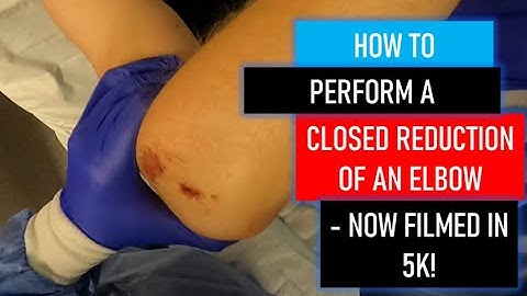 TRAUMA: How to perform a Closed Reduction of an Elbow Dislocation