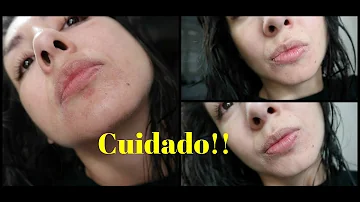 Pode passar hidratante em cima do ácido?