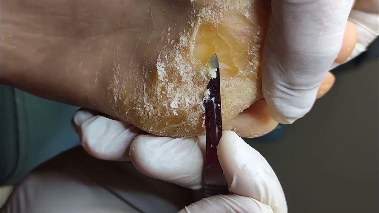 Removing Extremely Hard Foot Callus 🦶 The right way to remove foot