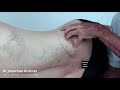 How to Release Trigger Points - Gluteus Medius (Low Back Pain)