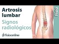 Artrosis lumbar - Signos radiológicos