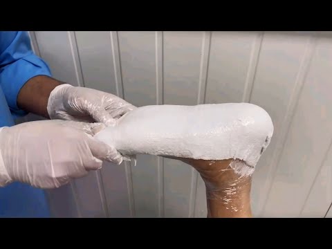 Insole Casting | Flat feet | Medial Arch