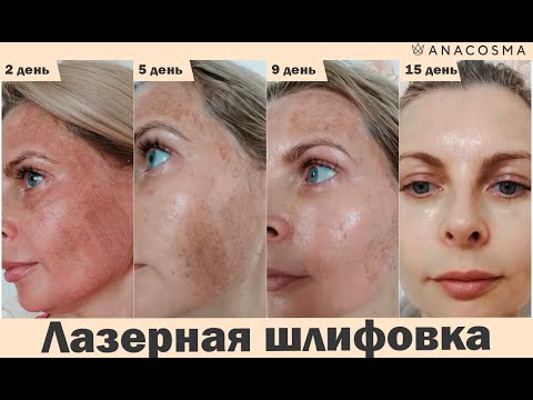 ❗️Лазерная шлифовка лица: до и после❗️❗️❗️ Реальный результат❗️❗️❗️