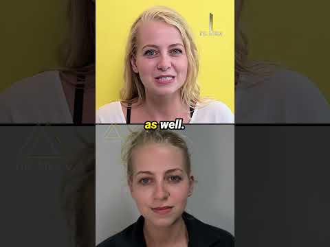 Buccal fat removal patient testimonial, real experience and review with Dr. John Mesa
