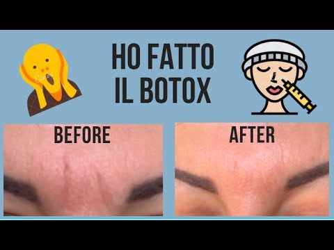 HO FATTO IL BOTOX (+ACIDO IALURONICO)! LA MIA ESPERIENZA PASSO PER PASSO! | hornitorella