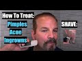Get Rid of Pimples, Acne, and Ingrown Hairs Faster with Alum! 4K
