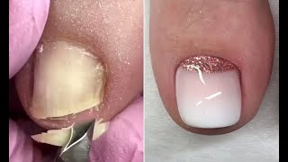 Most Satisfying Pedicure and Ingrown Nail Treatment #1