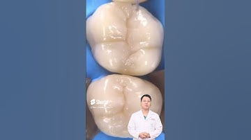 Trám Răng |Dr Cường Offical #bacsicuong #rangsuthammy #saurang #thammyrangsu #implant