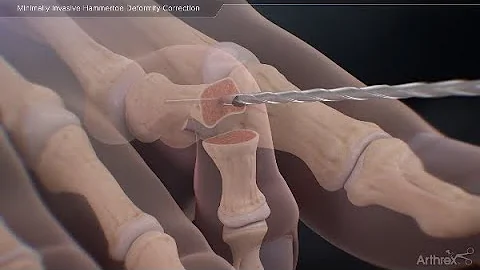 Minimally Invasive Hammertoe Deformity Correction