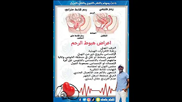 اعراض هبوط الرحم 