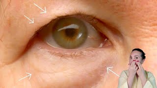 Effective Massage Techniques For Puffy Eyes Under Eye Bags And Droopy Eyelids