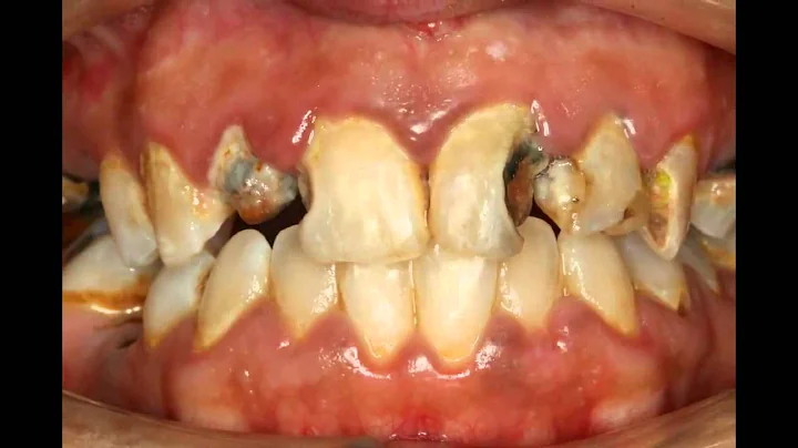 Cosmetic Dentist Sydney - Before and After - Implants, Porcelain Veneers, Smile Makeover