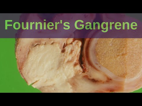 What is Fournier's