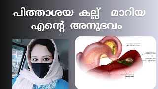 പിത്താശയകല്ല് മാറിയ എന്റെ അനുഭവം ?? My experience with passing gallstones?? 100% /Malayalam