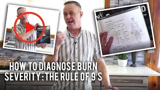 How to Diagnose Burn Severity The Rule of 9’s
