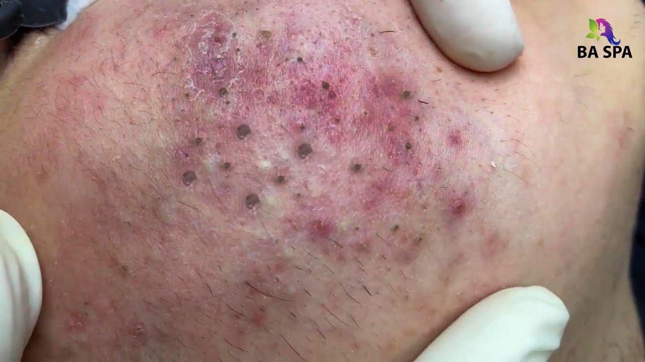 Relax Everyday With Spa 300 Popping Huge Blackheads And Pimple Popping