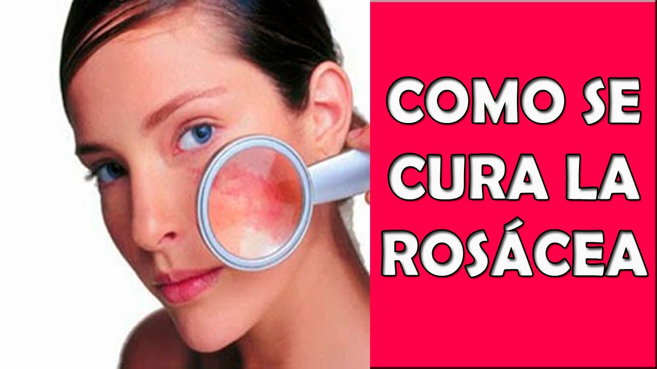 el acne rosacea tiene cura