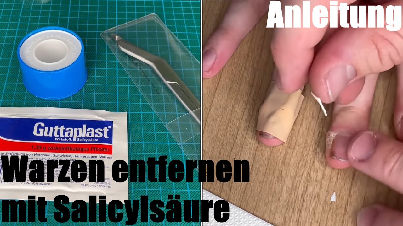 Wie Entfernt Man Eine Warze www.youtube.com