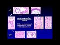 2021 Classic Lectures in Pathology: What You Need to Know: Breast Pathology- A CME Teaching Activity