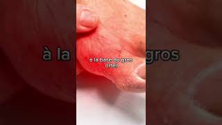 La Crise De Goutte Explique En 1 Minute