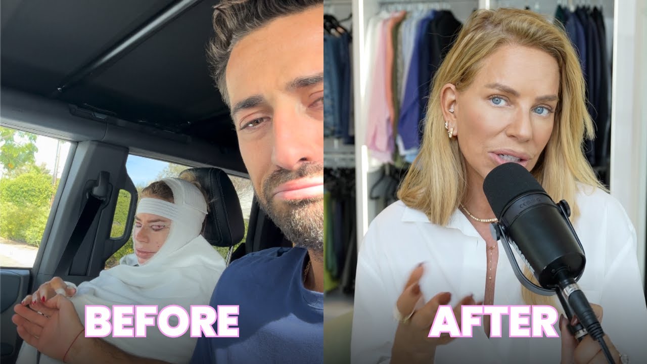 FACELIFT... The truth and personal experience