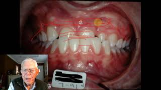 Class 3 Cleft Palate With Closed Skeletal Bite & More