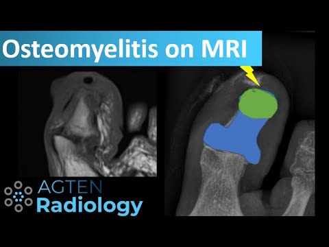 Video: Een Multicenter Gerandomiseerd Placebo-gecontroleerd Onderzoek Met Rifampine Om Pedaalamputaties Voor Osteomyelitis Bij Veteranen Met Diabetes Te Verminderen (VA INTREPID)