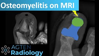 How to assess Osteomyelitis on MRI