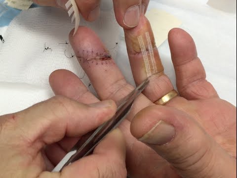 Hand Lac Suture Removal By Dr. Gonzo, More Houston Rain!