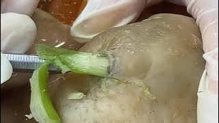 The Old Man's Cystic Are Like Flowers, Completely Restored #0808M20081