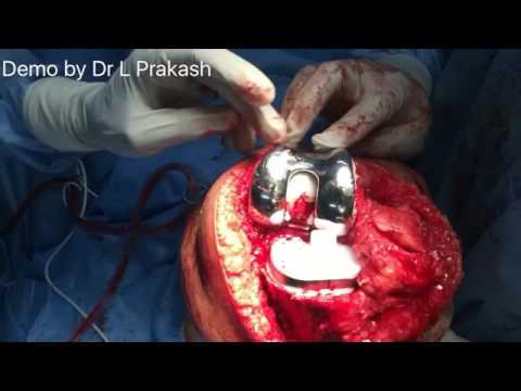 Master techniques for cementation in Primary TKR