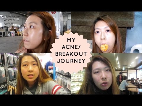 SKIN TALK: MY ACNE/BREAKOUT JOURNEY! (TAGLISH) | Rhia Banana