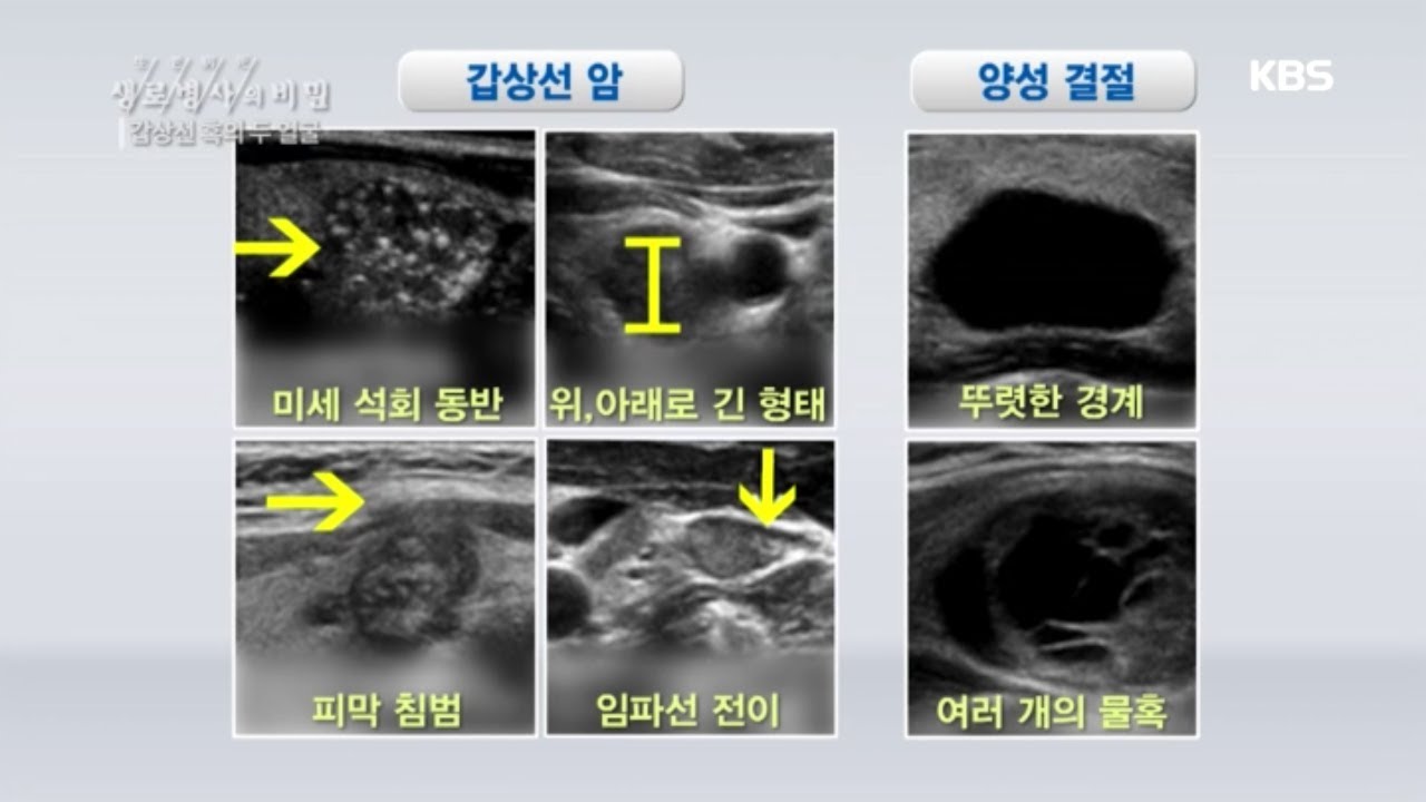 갑상선 혹의 두 얼굴, 갑상선 암과 양성 결절 [생로병사의 비밀] 20200617