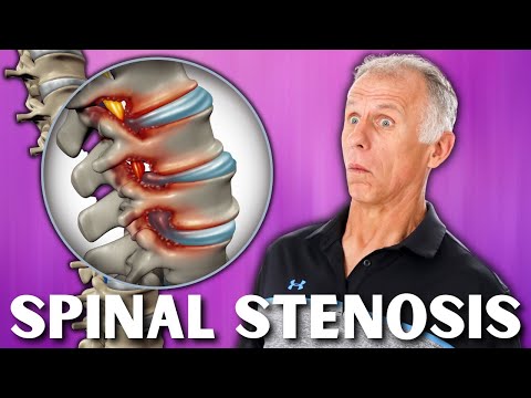 Cervical Spinal Stenosis | Q&A with Dr. Brian J. Neuman. 