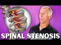 Top 3 Exercises For Spinal Stenosis