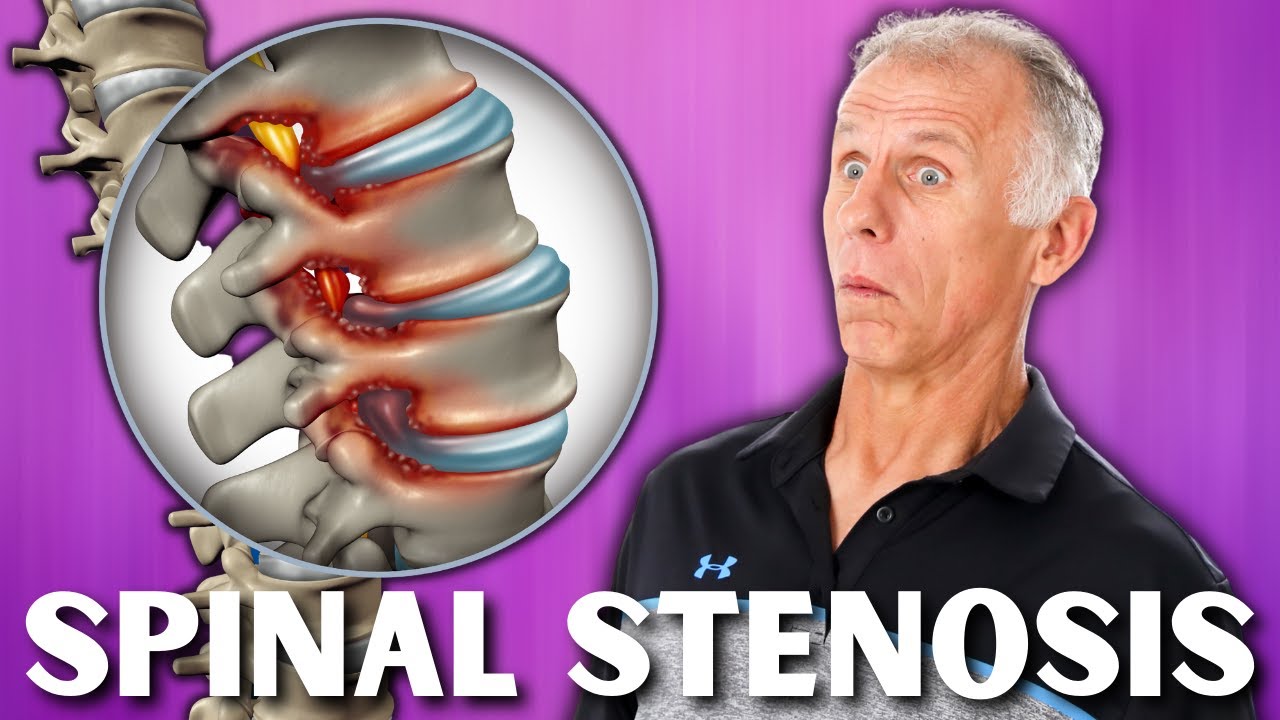 Top 3 Exercises For Spinal Stenosis Youtube