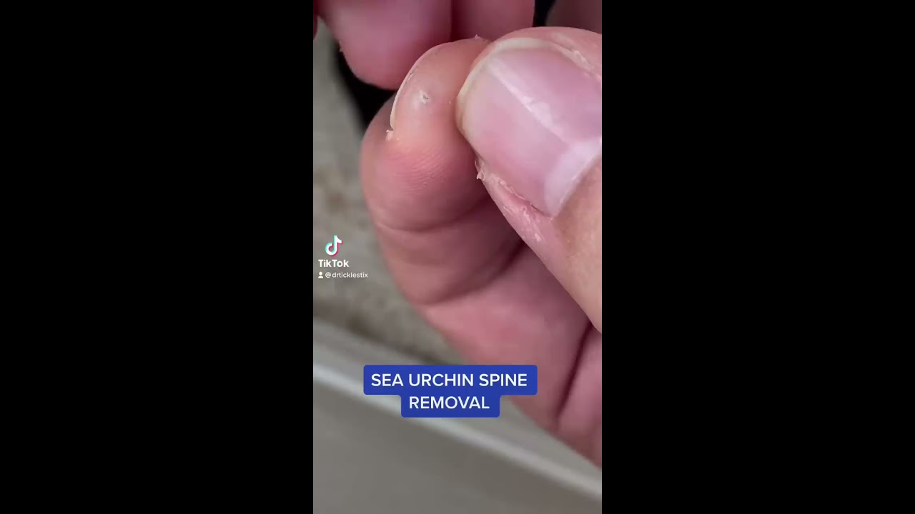 SEA URCHIN SPINE IN MY FINGER REMOVAL Shorts Shortsvideo Fyp